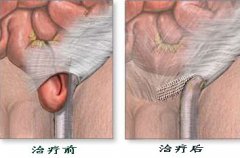 精索静脉曲张术后为什么会复发