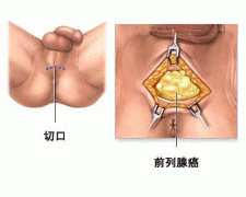 男性前列腺癌都会有哪些症状