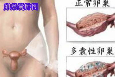 多囊卵巢综合症有哪些症状